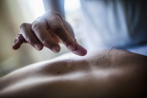 Quels sont les avantages de l'acupuncture pour le soulagement de la douleur chronique ?
